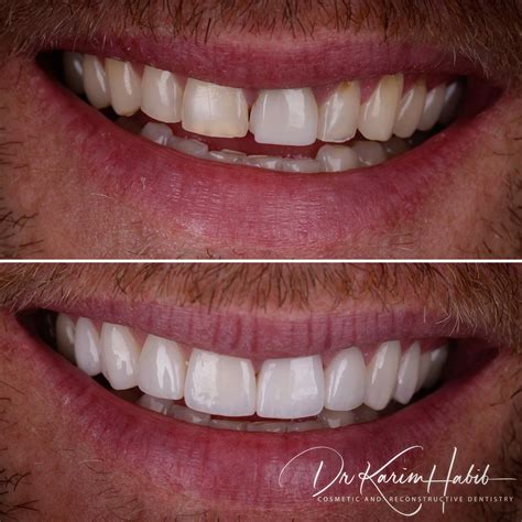 Porcelain Veneers Sydney Best Composite Dental Veneers Sydney