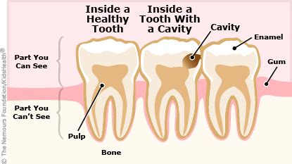 Be sure to have regular checkups and cleanings, since that's when your dentist finds treatment depends on how bad the cavity is. A to Z: Dental Cavities