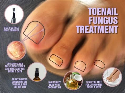 To prevent and treat foot/toe fungus, put clean shoes in plastic bags and put bags in freezer for 72 hours, this will kill any fungus in shoes. Tried And True Home Remedies For Nail Fungus