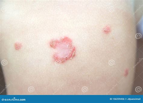 Infezione Batterica Contagiosa Dermatologica Impetigine Sulla Pelle Del Bambino Senza