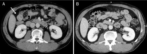 Adult Small Bowel Intussusception Detected At Abdominal Ct A Small