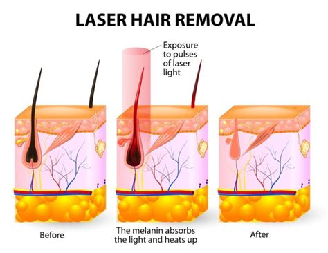 A Complete Guide To Laser Hair Removal Woman Reigns