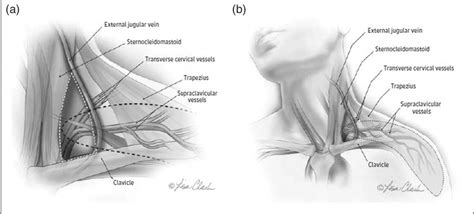 Figure 1 From Update On The Supraclavicular Flap Semantic Scholar