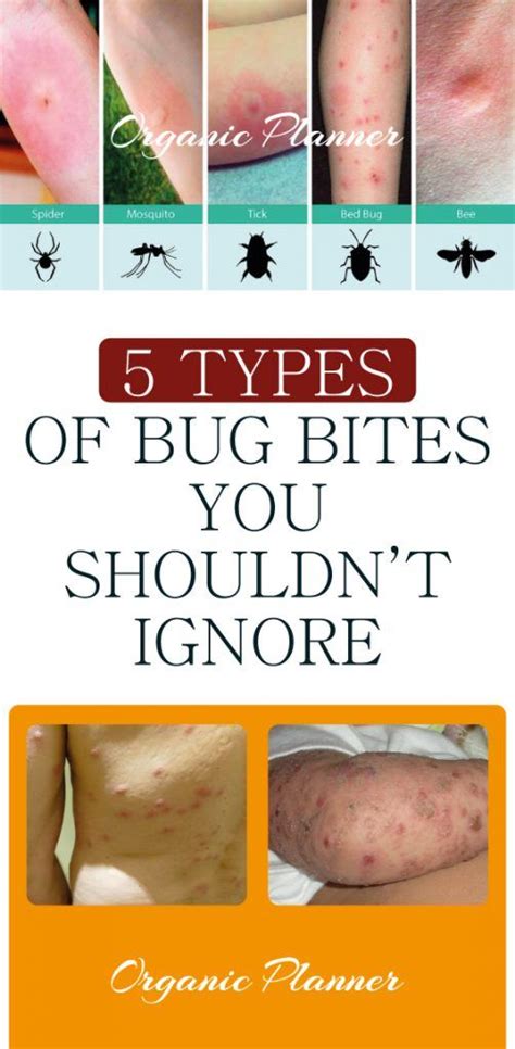 Can You Recognize Your Bite Spot In Any Of These 5 Types Of Bug Bites