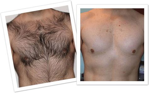 Men Hair Chest Before After 1 1 Shahnaz S Beauty Garden Hair And Spa