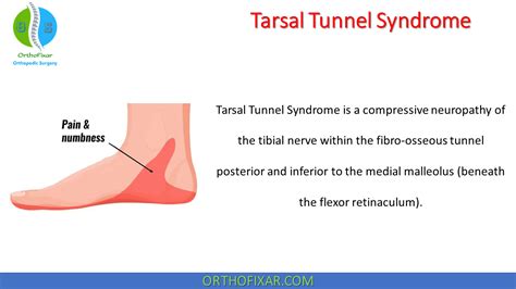 Tarsal Tunnel Syndrome Orthofixar 2023