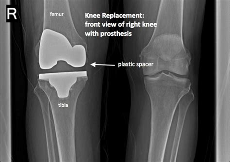 Knee Xray Upper West Side Columbus Circle New York Ny