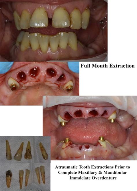 Normal Tooth Extraction Healing Pictures