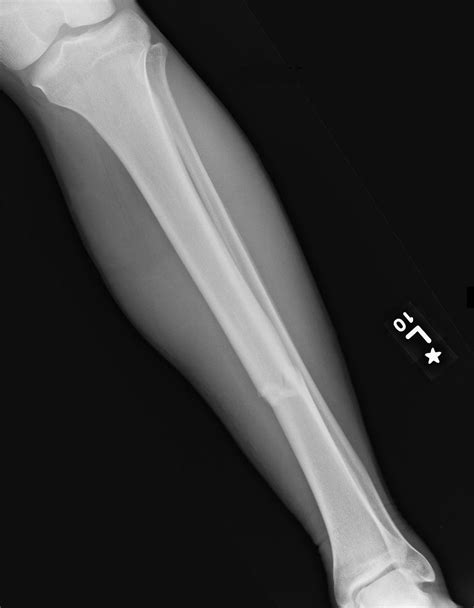 In rockwood and wilkins' fractures in children, 7th ed. Roentgen Ray Reader: Isolated Tibial Diaphysis Fractures