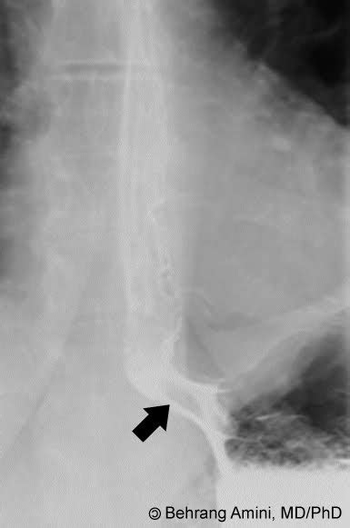 Roentgen Ray Reader Inflammatory Esophageal Pseudopolyp