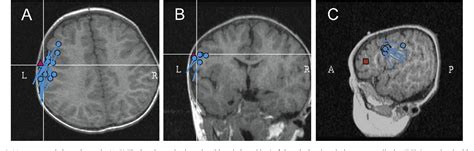 Figure 2 From A Boy With Unilateral Neck Myoclonus Of Cortical Origin