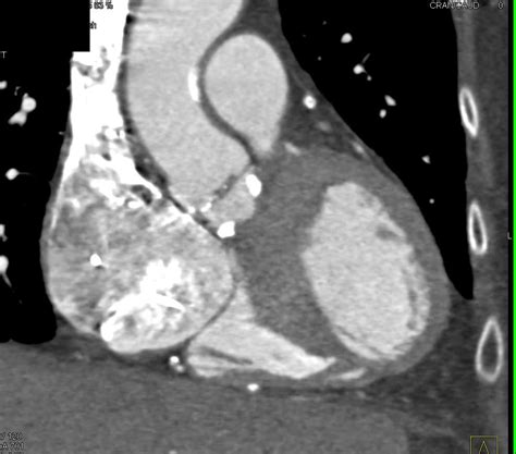 Aortic Valve Calcification And Aortic Stenosis Cardiac Case Studies