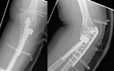 Postoperative Radiographs Osteosynthesis Of The Ulna Was Performed