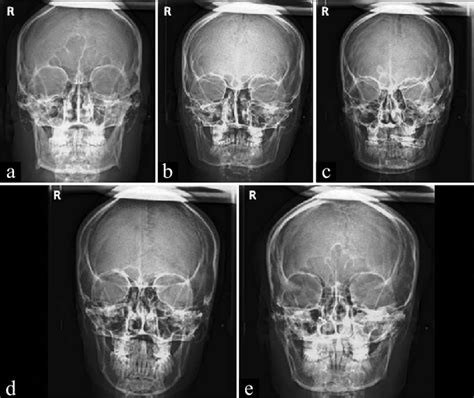 Various Nasal Septum Patterns A Straight B Right Deviated C Left Download Scientific