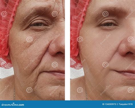 Terapia Facial De Las Arrugas De La Mujer Mayor Antes Y Después De