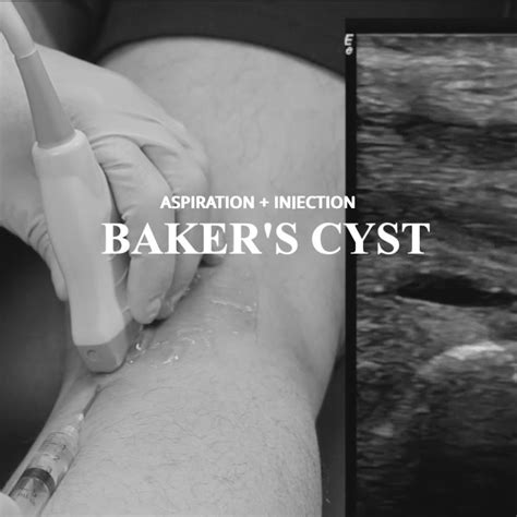 Bakers Cyst Diagnosis And Aspiration Must Msk Ultrasound