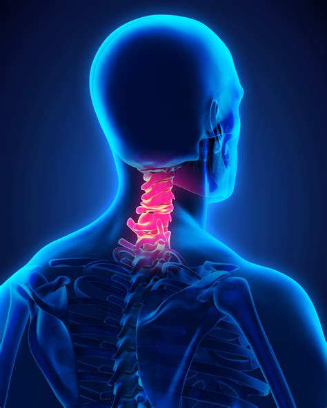 Cervical Laminectomy And Fusion Manhattan Spine Consultants