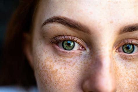 How To Get Rid Of Freckles 2023 7 Simple And Quick Ways