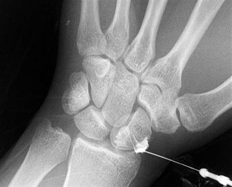Lateral Approach For Radiocarpal Wrist Arthrography Ajr