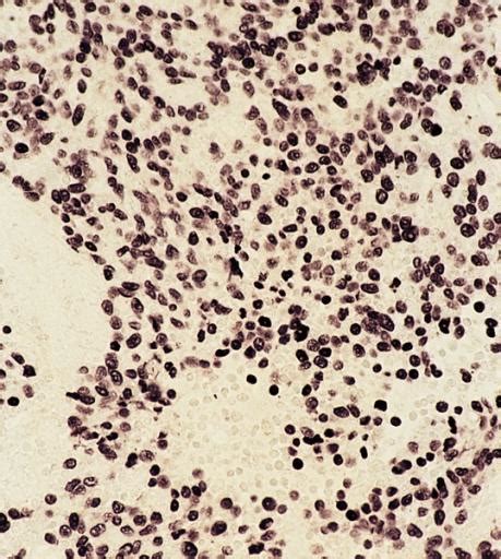 Nasopharyngeal Lymph Tissue
