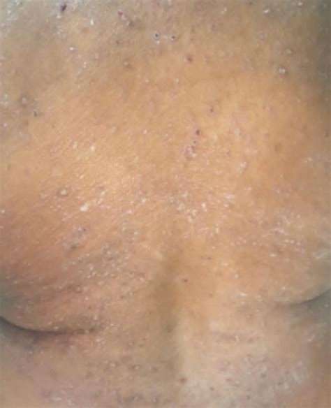 Rash Hepatitis C Lichen Planus Photos My Xxx Hot Girl