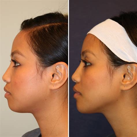 Rhinoplasty With Dr Diamond The Best Nose Jobs In America Justinboey