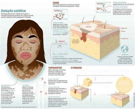 Vitiligo O Que é Causas Sintomas Prevenção Tipos Tratamento Zohal