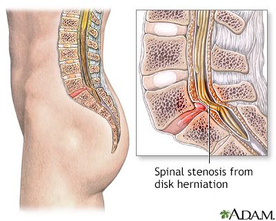 Spinal Stenosis Symptoms Doctors Treatments Advances More MediFind