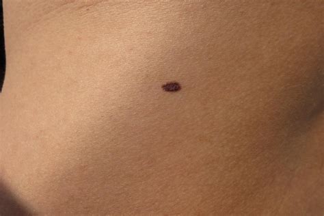 Mole On Arm Meaning Check If The Border Of The Mole Becomes Irregular Dareyap