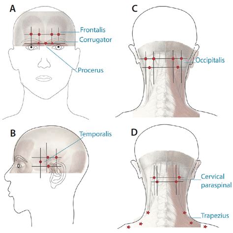 Headache Occipital Pain Cluster Headaches