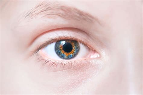 Central Heterochromia Types And Causes