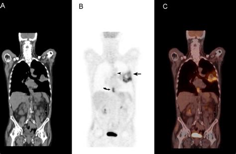 Pet Scan Can Detect Cancer