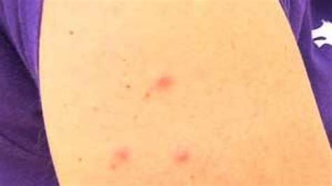Swimmers Itch Caused By Parasites That Penetrate The Skin Cbc News