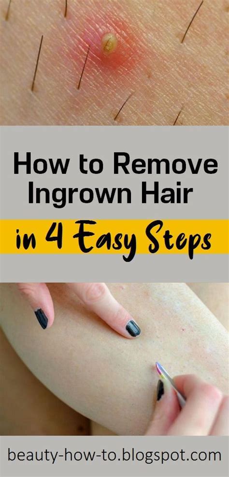How To Remove Ingrown Hair In 4 Easy Steps Ingrown Hair Removal