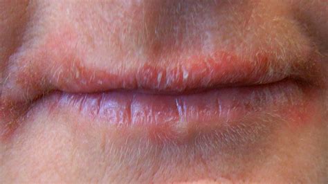 Bumps On Lips Causes Treatments And More