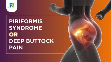 Piriformis Syndrome Deep Buttock Pain Diabetes Care Plan In Mumbai
