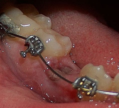 It almost feels as the pain would feel before having a root canal. Extreme pain on gums after tooth extraction (pics included)