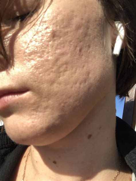 Co2 Laser In Treating Acne Scars Ultrapulse And Subcision Of Acne Scars W Dr Lim Dr Rullan And