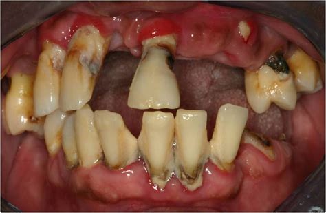 Smoking Gum Disease And Tooth Loss Dangers Of Tobacco Tidatabase