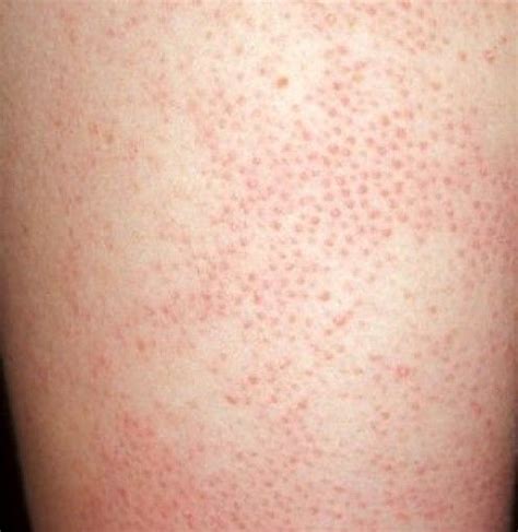 How To Get Rid Of Bumps On Arms Patchy Skin Red Patchy Skin Bumps