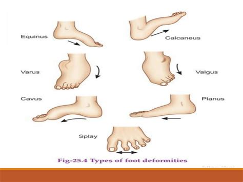 Solution Congenital Talipes Equino Varus Ctev Clubfoot Studypool