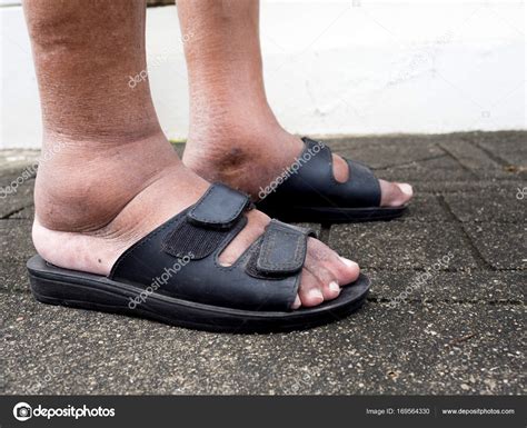 The Feet Of Man With Diabetes Dull And Swollen Due To The Toxicity Of