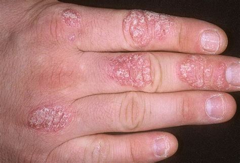 Psoriasis On Hands Photos Symptoms And Pictures