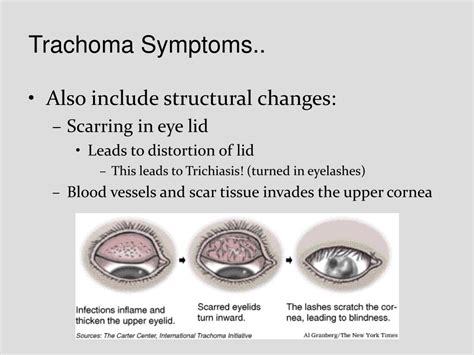 Ppt Trachoma Powerpoint Presentation Free Download Id3029397