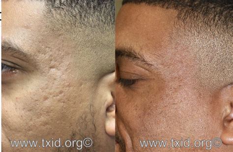 Do You Have Anything To Get Rid Of Acne Scarring On African A Merican