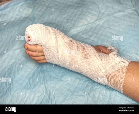 Bloody Toe And Hurt Leg Wounded Children Leg With Bandaged Ankle And