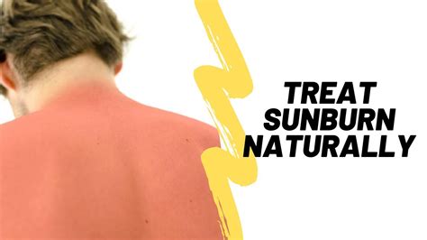 Natural Home Remedies For Sunburn Sunburn Prevention Relief And