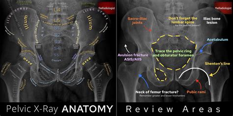 Pelvic X Ray Anatomy And Interpretation Checklist Grepmed