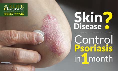 Control Skin Disease With Treatments From Ayurveda Ayurveda Psoriasis