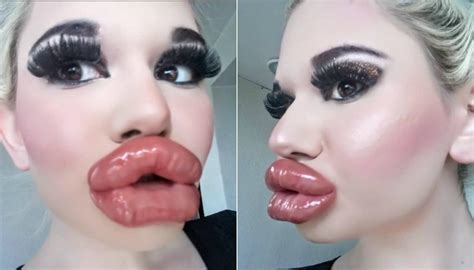 Woman With World S Biggest Lips Says She S Not Done With Injectables Newshub